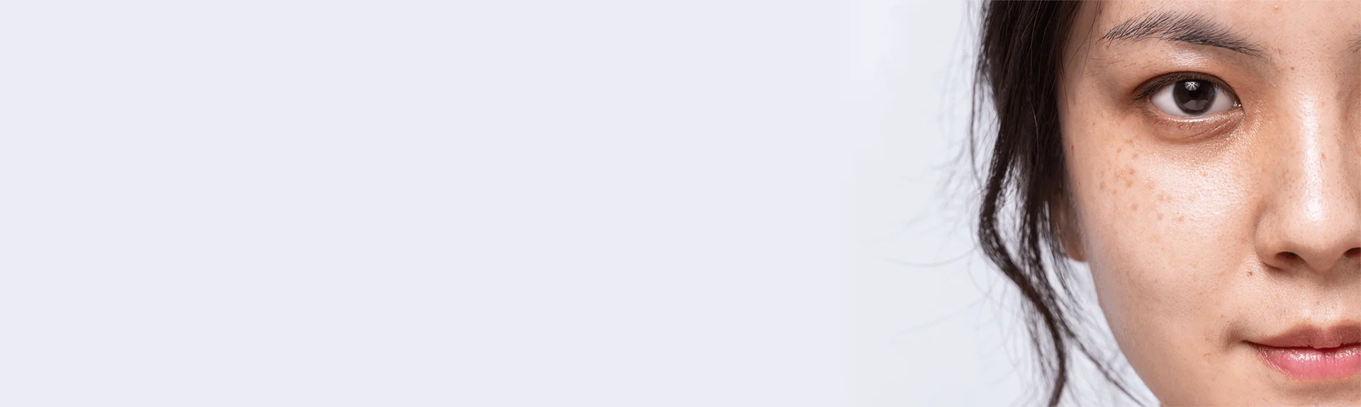 Ketahui penyebab dan ciri Hori’s Nevus (ABNOM)