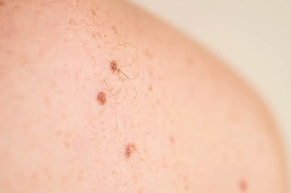 Seboroik keratosis tidak akan berubah menjadi kanker kulit, namun pada beberapa kasus bisa sulit dibedakan dengan melanoma (kanker kulit ganas)