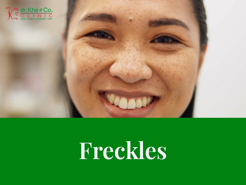 layanan dr.khe & co | freckles - Klinik Kecantikan di Kelapa Gading