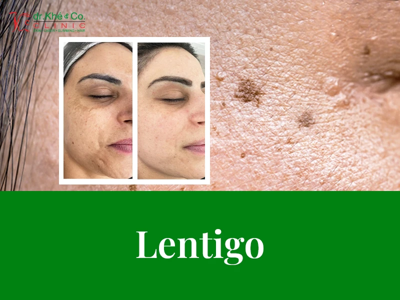 layanan dr.khe & co | lentigo - Klinik Kecantikan di Kelapa Gading
