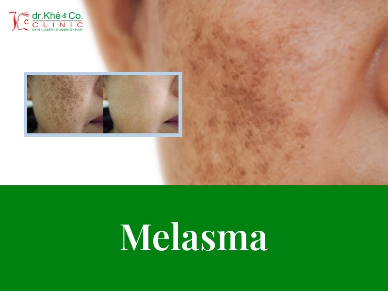 layanan dr.khe & co | melasma - Klinik Kecantikan di Kelapa Gading
